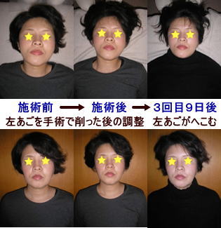 整形外科で約15年前に顎関節症で左あごを削る手術後の頭蓋骨、小顔矯正写真