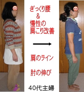 肩の反りすぎで肩こり事例写真