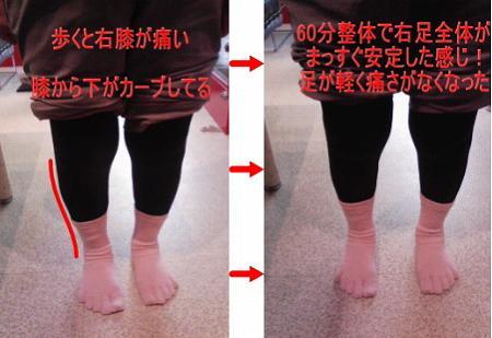 膝から下のO脚を改善して膝痛改善