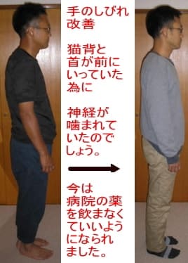 手のしびれ改善事例写真