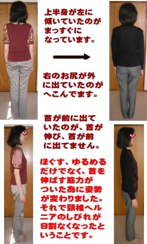 頸椎ヘルニアでの四肢のしびれ改善事例写真