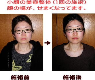 小顔の美容整体改善事例写真