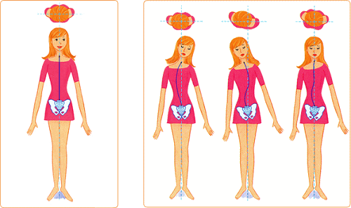理想の骨格と歪みの骨格の姿勢例図