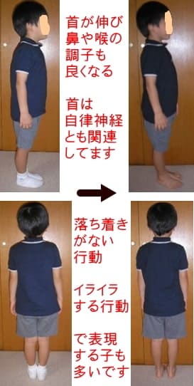 首が伸び、自律神経も良くなったのか鼻がとおり、喉もスッキリした5歳児の姿勢写真