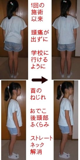 1回の施術以来、頭痛が出ずに学校に行けるようになった10歳女の子の姿勢写真
