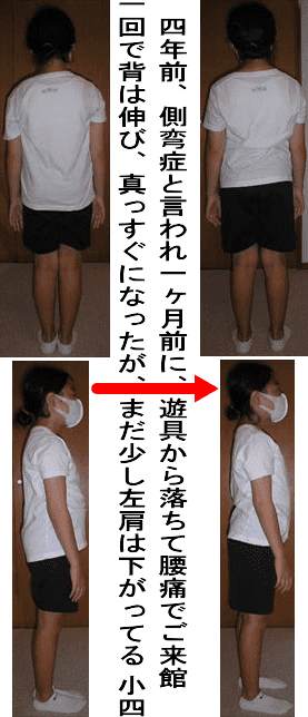 側弯症の改善の写真事例