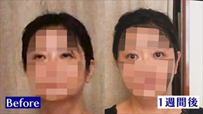 整体を受けたあとも目がパッチリが続いている写真